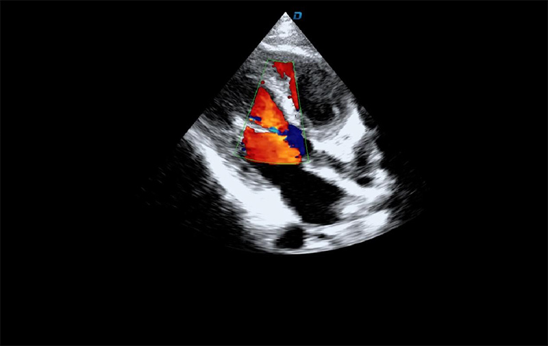 心臟彩超機檢測圖